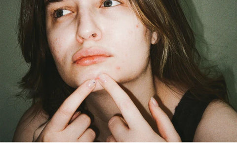 How to manage period acne